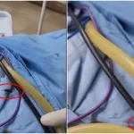 پشاور: کڈنی ڈیزیز میں سرجری کے دوران مریض پر لال بیگ چلنے کی ویڈیو وائرل