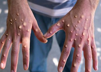 کراچی میں منکی پاکس کا دوسرا کیس رپورٹ